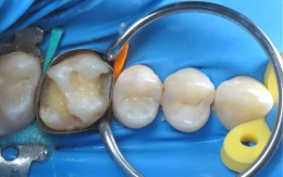 Fixing wooden wedges - one colour (100 pcs box), green - thin, short - TOR VM